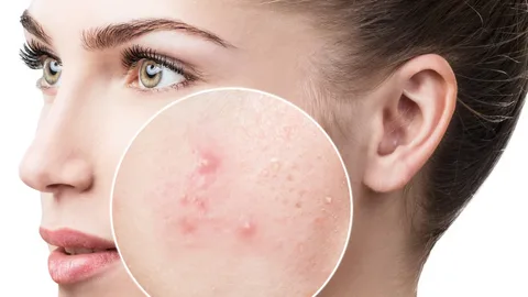 acnee vulgara tratament